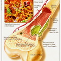 osteomyelitis.jpgCres.jpg